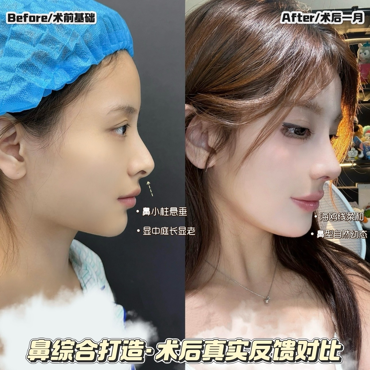 随着年龄的增长，面部皮肤逐渐松弛下垂幼态脸能改善吗(图5)