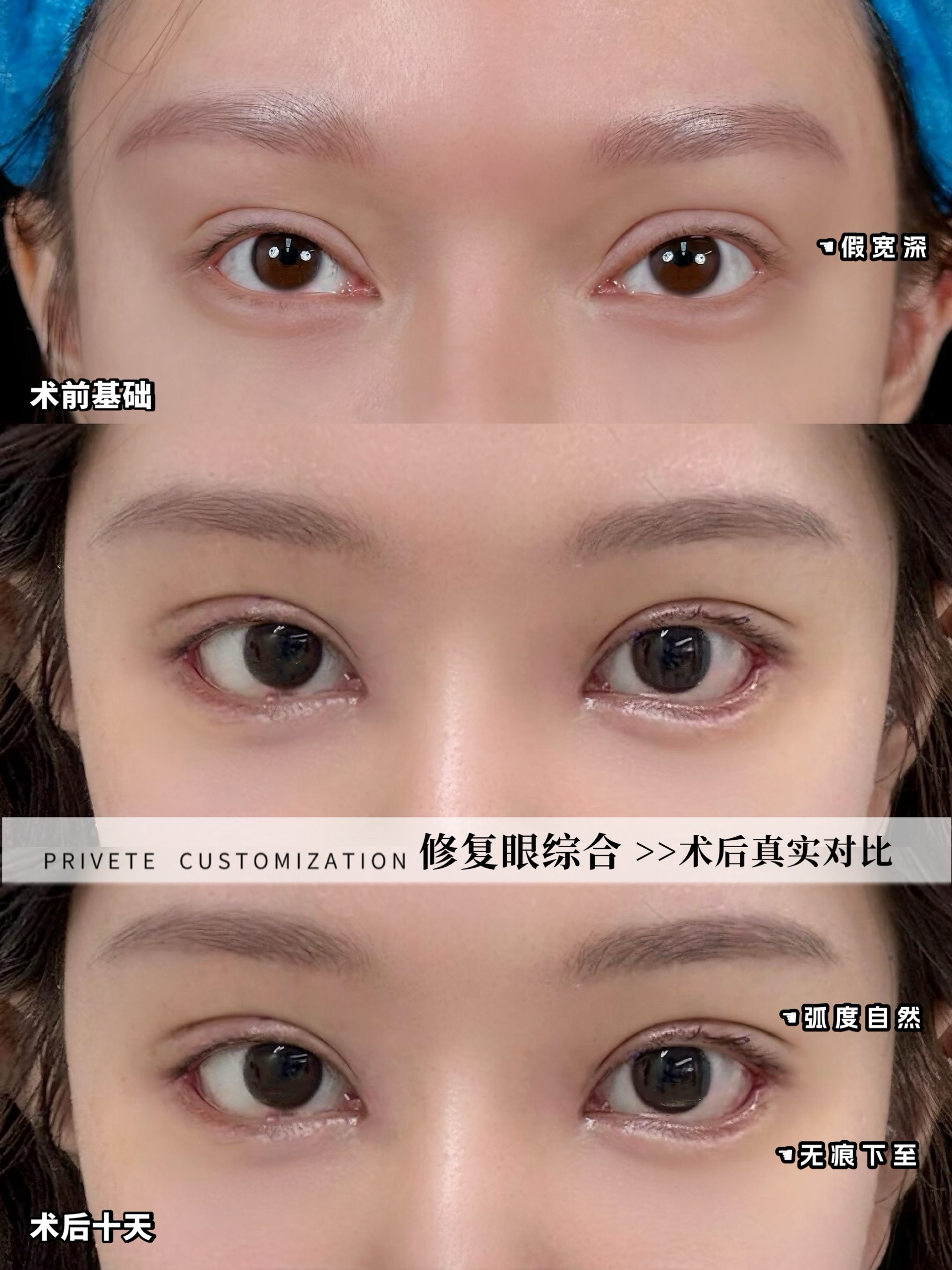 做鼻子的注意事项，有没有避坑指南幼态脸(图6)